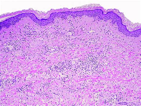 Superficial And Deep Dermal Interstitial Neutrophilic Infiltrate The