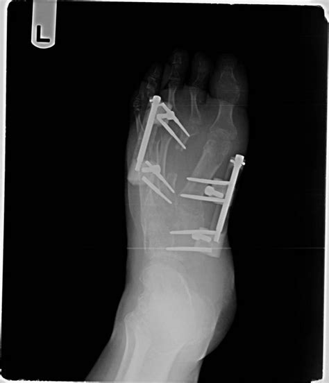 Nonunion The Foot And Ankle Online Journal