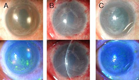 A 44 Year Old Man With Diffuse Corneal Edema And Bulla With Intractable