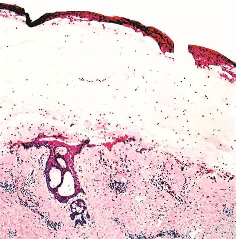 Pathology Outlines Pemphigoid Gestationis