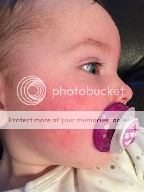 Baby Has Rash On Face What Could It Be Pic Babycenter