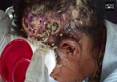 Homeless Indian Woman Whose Head Infested With Maggots Saved By