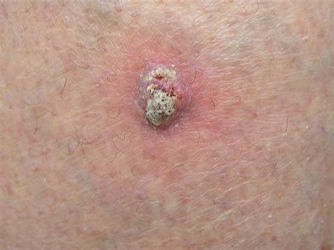 Skin Cancer Prevention Treatment And Care