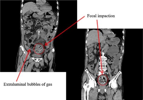 Ct Scan Image Of Case 1 The Fecal Impaction And Intestinal Pneumatosis