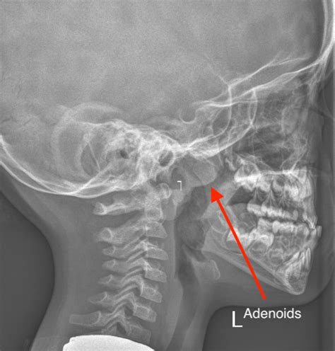 Adenoid Hypertrophy X Ray