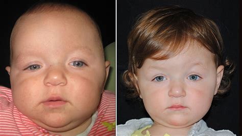 Craniosynostosis Surgery Childrens Hospital Of Philadelphia