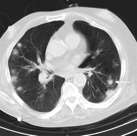 Invasive Pulmonary Aspergillosis In Patients With Chronic Obstructive