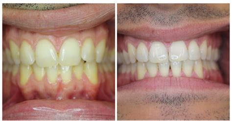 We did not find results for: Adult Invisalign Special with NYC Elite Invisalign Dentist ...