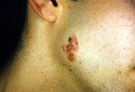 Benign Skin Lesions Nevi Cysts Naevus Naevocytic Picture