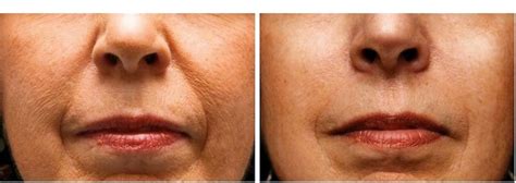 Bellafill Artefill The Beauty That Lasts Collagen Injection In Oc