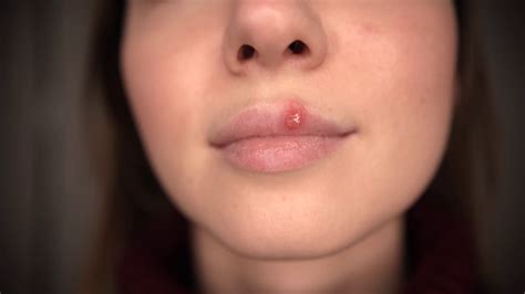 Herpes On Girls Lips Stock Footage Sbv 329058389 Storyblocks