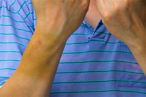 Large Bruise In The Forearm Injection Bruises Stock Photo Download