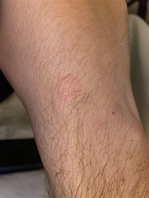 Strange Red Circles Appearing On Skin Not Itchy Rdiagnoseme