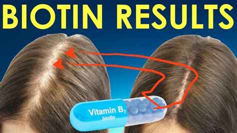 We don't recommend it—there's no evidence that it's an effective hair growth supplement, and it can even be harmful. BIOTIN HAIR GROWTH RESULTS before and after - BIOTIN ...