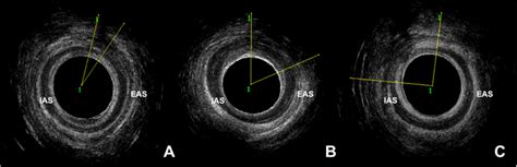 Endoanal Ultrasonography Findings Of Three Different Women 3 Months Download Scientific Diagram