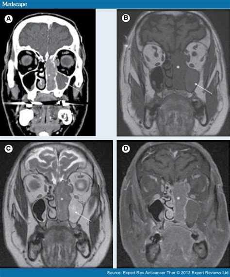 Imaging And Resectability Issues Of Sinonasal Tumors