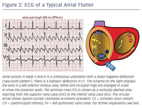 Figure 2 Ecg Of A Typical Atrial Flutter Radcliffe Vascular
