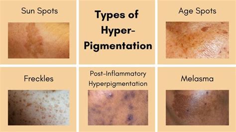 Hyperpigmentation Types And Treatments Essential Life Skin Products