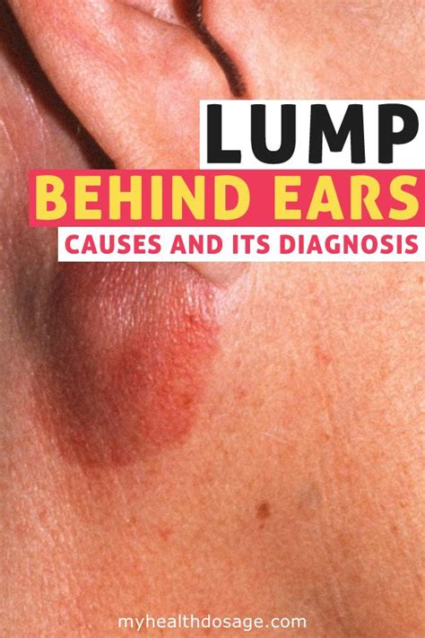 What Causes Lumps Behind The Ears What To Do When You Have A Lump