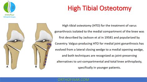 High Tibial Osteotomy 2023 Orthofixar