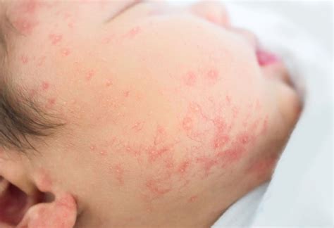 Baby Rash Pictures Causes Treatments Baby Baby Pictur