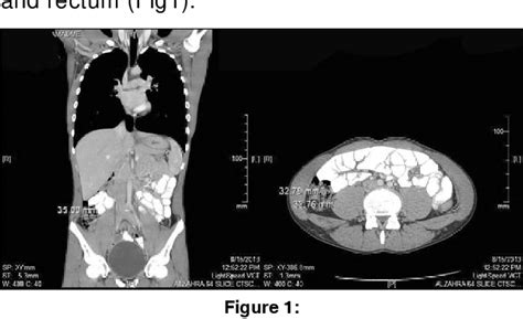 Figure 1 From Radiologic Manifestations Of Chronic Constipation In Ct