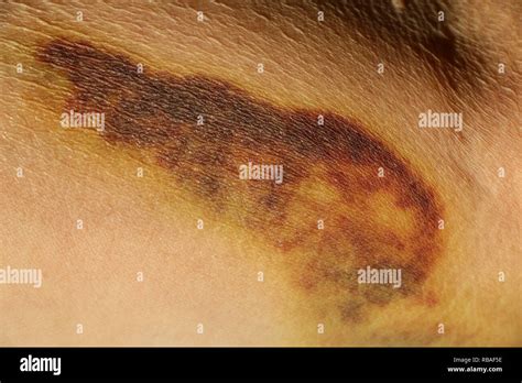 Bruise On Skin Of Hand Of An Elderly Woman Close Up Photo Stock Photo