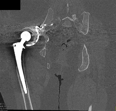 Failed Right Total Hip Replacement Thr With Dislocated Hip