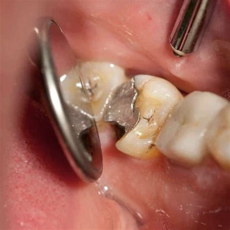 Brokencracked Teeth Pasadena Dental And Implant Centre