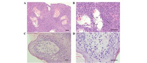 Middle Ear Squamous Papilloma A Report Of Four Cases Analyzed By HPV And EBV In Situ Hybridization
