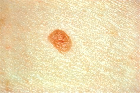 Basic Skin Care Tips Signs Of Skin Cancer Moles And What To Look For