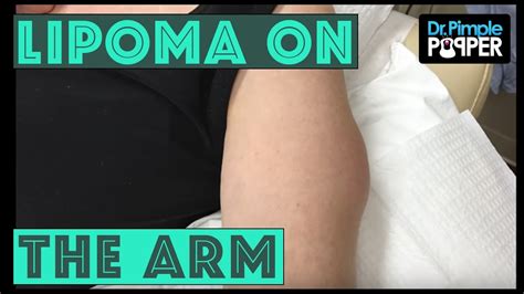 A Lipoma International On The Arm Youtube