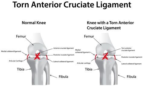 what football players need to know about acl injuries performance health 32400 hot sex picture