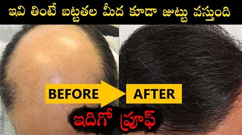 How To Grow Hair On Bald Head Naturally Health Tips In Telugu