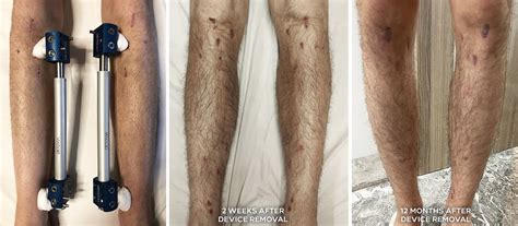 Leg Lengthening Surgery Scars Types Differences And Treatments
