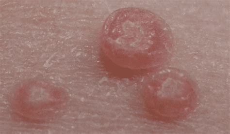 Molluscum Contagiosum Pictures Symptoms Causes Treatment Hubpages