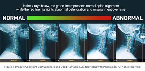 The Cervical Curve Ruach Chiropractic