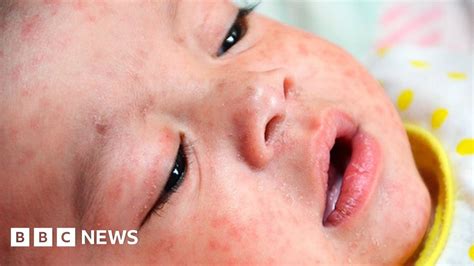 Measles Outbreak Across Europe Bbc News