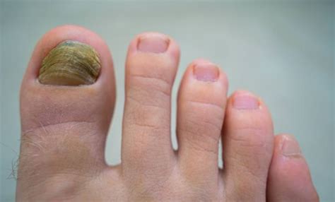Causes And Treatments Of Yellow Toenails