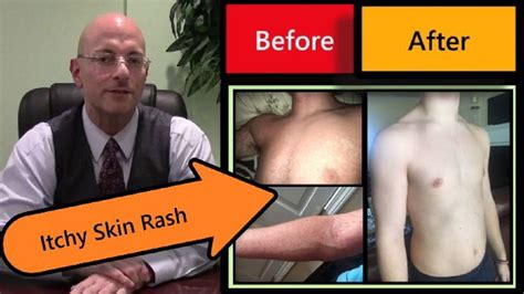 How To Get Rid Of Itchy Skin Rash Youtube