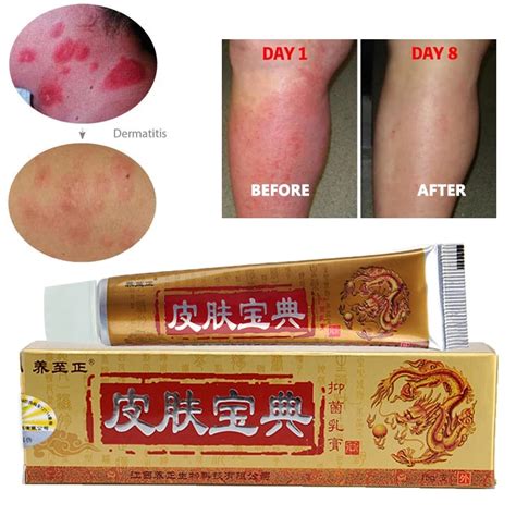 15g Psoriasis Cream For Dermatitis And Eczema Pruritus Psoriasis