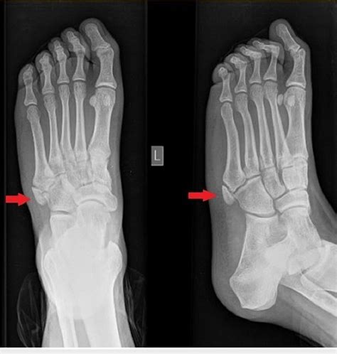 Plain Radiograph Ap And Lateral Oblique Of The Left Foot Injured