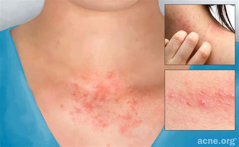Contact Dermatitis Skin Rash Treatment
