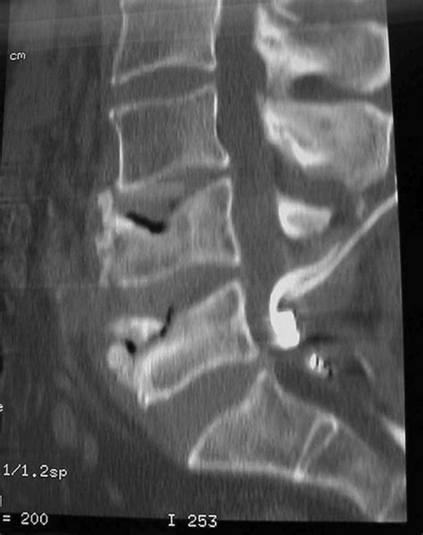 Lumbar Spine Ct Scan Causes Symptoms Treatment Lumbar