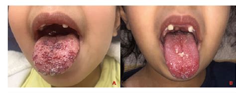 Figure 1 From Non Painful Severe Variant Form Of Eruptive Lingual