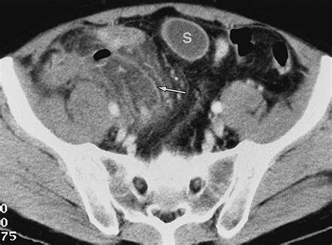 Ct Evaluation Of Small Bowel Obstruction Radiographics