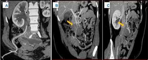 Full Text Retroperitoneal Desmoid Tumor With Unusual Appearance As A