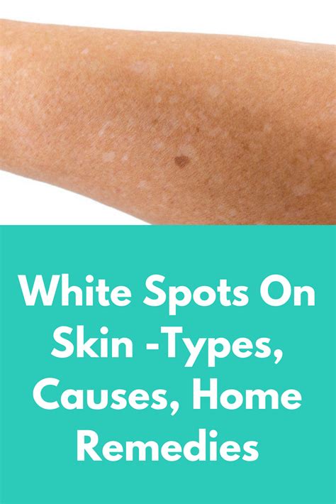 White Spots On Skin Types Causes Home Remedies This Article