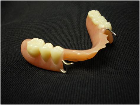 Owings Mills Partial Dentures Pikesville Partial Denture Towson