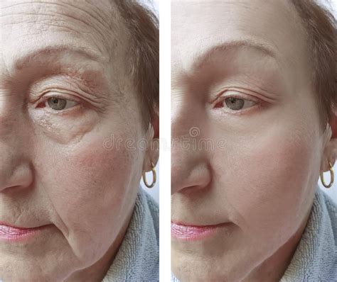 Elderly Woman Facial Wrinkles Before And After Cosmetology Procedures